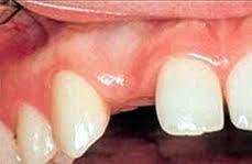 Dental Implants_Before