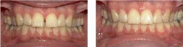Patient 2_Veneers_Before and After