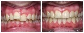 before and after braces2