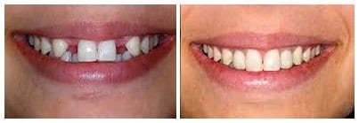 before-and-after-dental-implants1