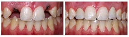 before-and-after-dental-implants4