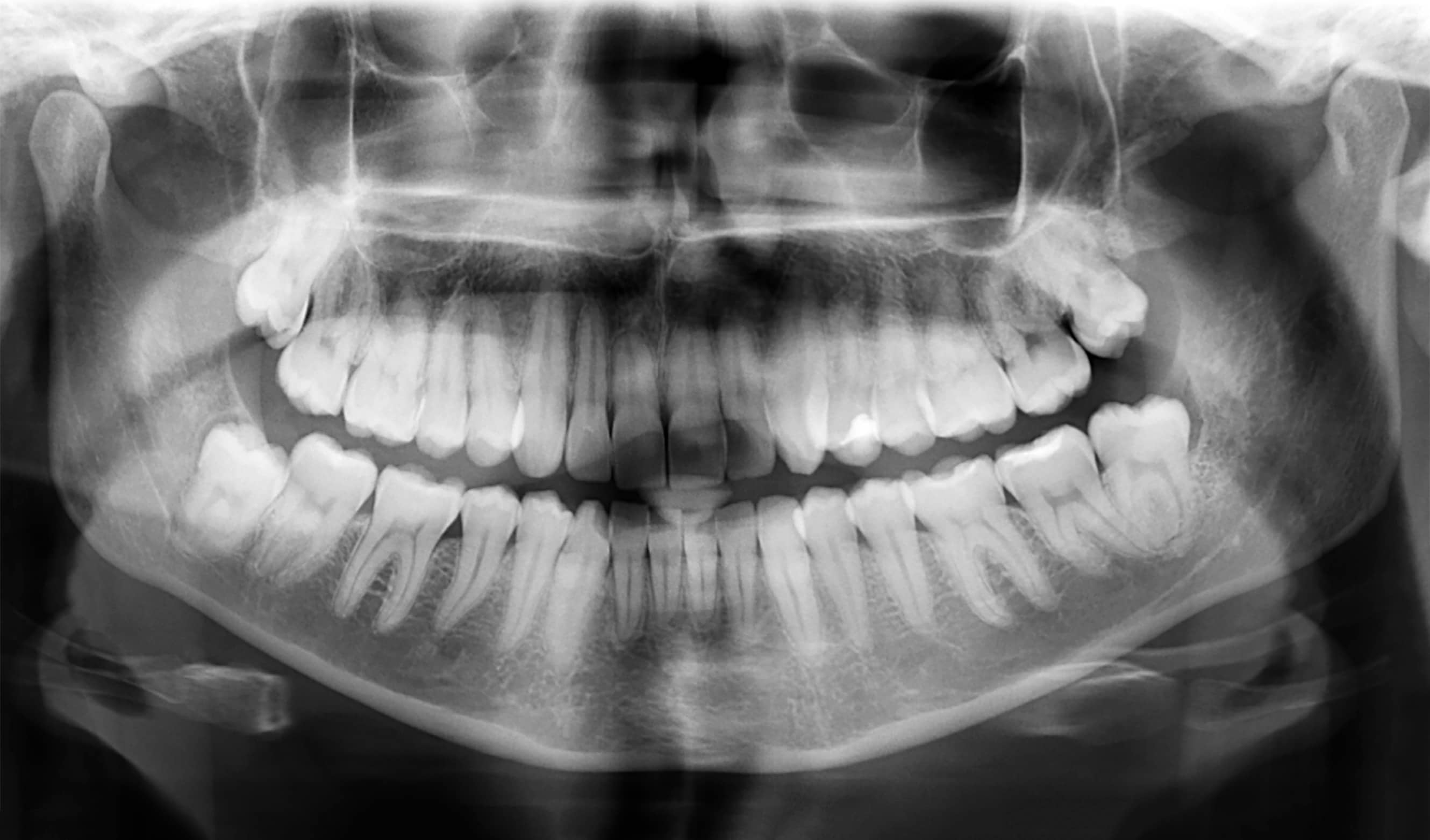 Dental X-ray, Smile Envy Dental Group, Atlanta, GA