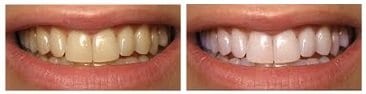 smile-envy-whitening-before-and-after