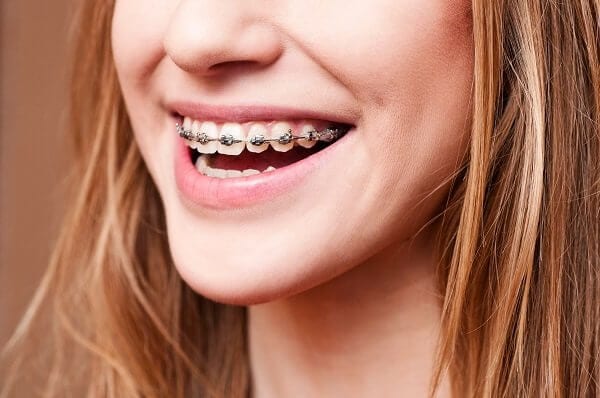 braces, teeth,